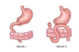 Billroth I und II
