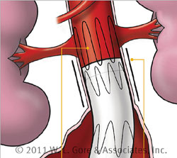 Stentgraft Position im Bereich der Nierenarterien