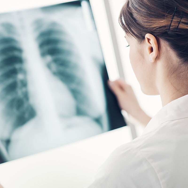 Female doctor examining a patient's x-ray of lungs and rib cage, radiology and healthcare concept