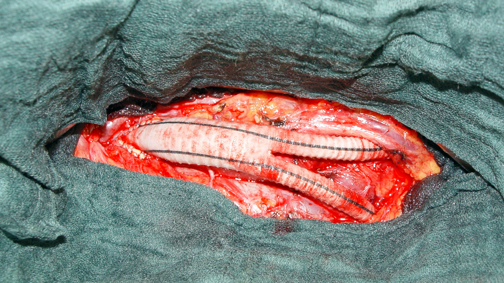Abschluss einer offenen Aortenaneurysma Operation nach Einnähen einer Aortenersatzprothese