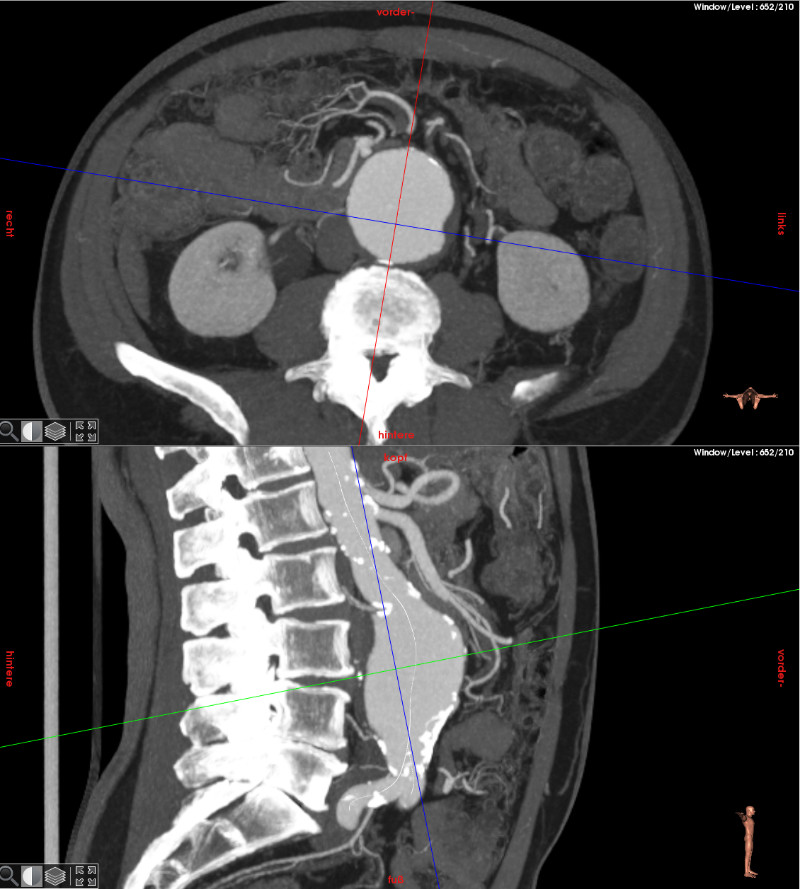 Vermessung der CT Bilder eines Aortenaneurysmas