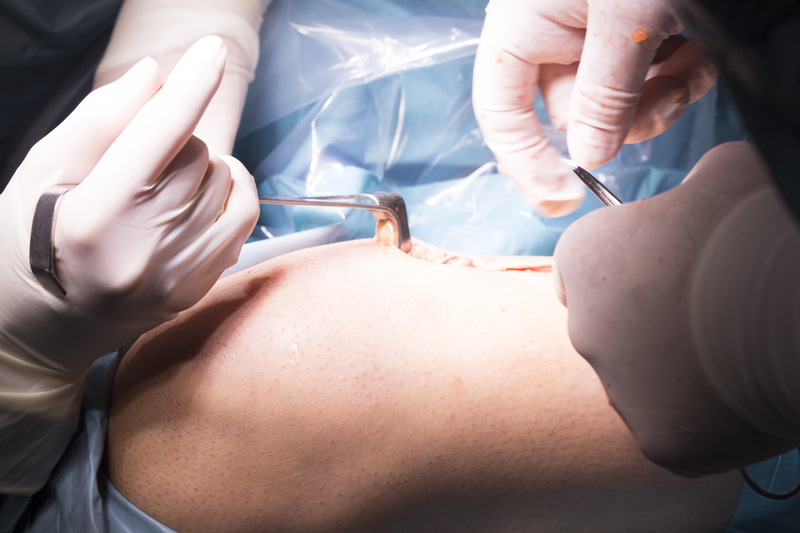 Surgical operation knee surgery / CopyrightEmail: edwardolive@hotmail.comWebsites: www.edwardolive.org www.weddingspain.es, Edward Olive Surgical operation knee arthroscopy micro surgery on knee, tendon, ligament and meniscus in hospital operating theater emergency room.