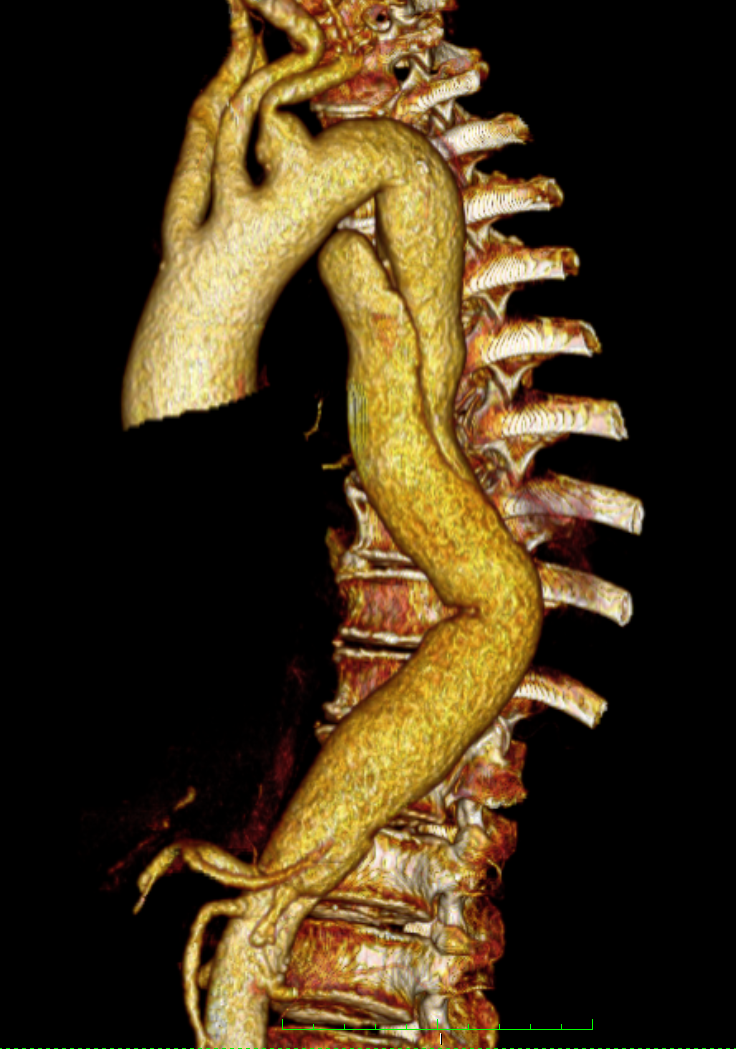 Dissektion der Aorta im Brustbereich VOR Behandlung mit Stentgraft