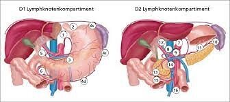 D1 und D2 Lymphknotenkompartiment