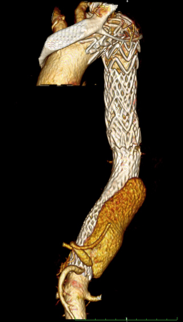 Dissektion der Aorta im Brustbereich NACH Behandlung mit Stentgraft