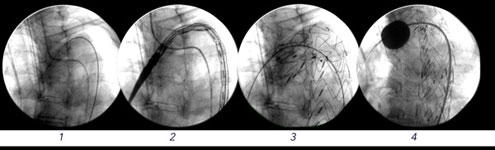 Stentgraftimplantation thoracale Aorta