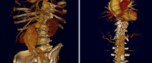 Hybridoperation – operative Bauchaortenaneurysmaresektion + Stentgraftimplantation thoracale Aorta (vor und nach der Operation)