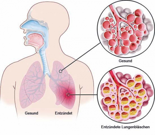 Lungenentzündung